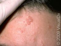 Molluscum Contagiosum – Adult