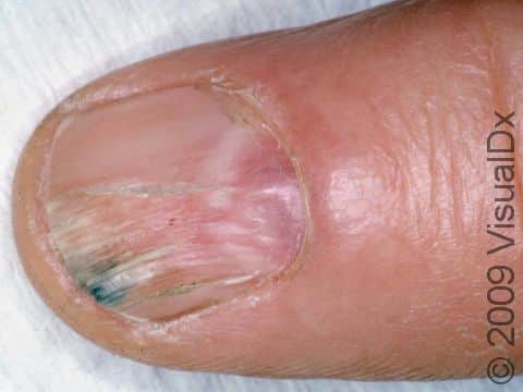 When myxoid cysts occur at the nail fold, they cause the nail to grow with lines, grooves, and cracks, as displayed here.