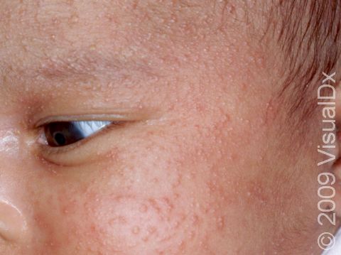 Neonatal acne can be severe with whiteheads covering the face, as in this newborn child.