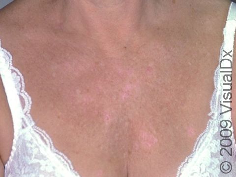 There are subtle light pink round, scaling patches of nummular dermatitis on this woman?s chest.