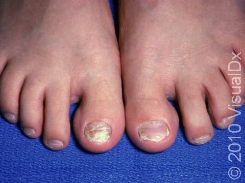 This image displays both great toenails infected with fungus.