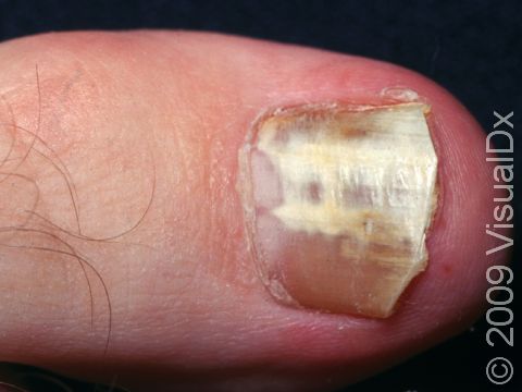 This form of fungal nail infection is call 