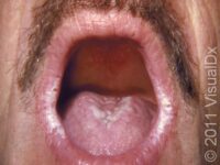 Thrush (Oral Candidiasis) – Adult