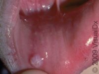 Oral Mucocele – Adult