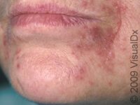 Perioral Dermatitis – Adult