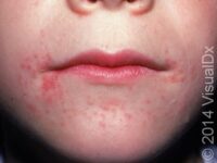 Perioral Dermatitis (Pediatric) – Child