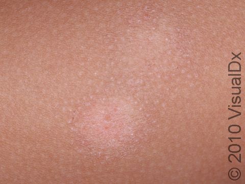 This image displays a close-up of pityriasis alba.