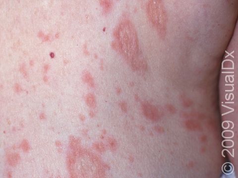 This image displays a rash with slight scaling that is typical of pityriasis rosea.