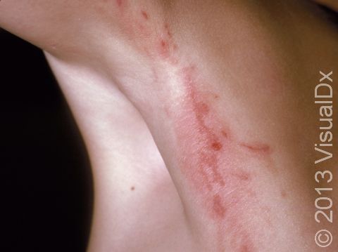 This image displays the line-like configuration of the inflamed skin lesions typical of poison ivy.