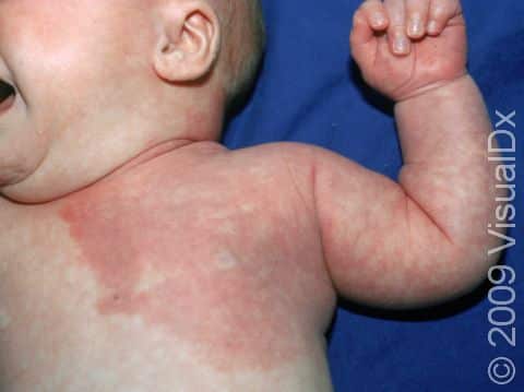 This infant has a port-wine stain of the left chest.