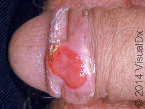 This image displays a chancre, and ulcer of primary syphilis.