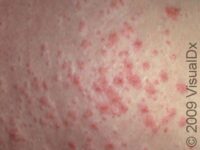 PUPPP (Pruritic Urticarial Papules Plaques of Pregnancy) – Adult