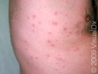 Hot Tub Rash (Pseudomonas Folliculitis) – Adult