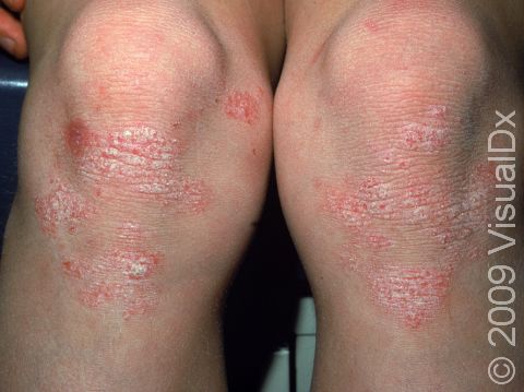 This image displays psoriasis affecting the knees due to excess friction from play and sports.