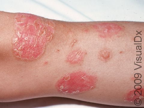 This image displays a close-up of the scaly, slightly elevated lesions of psoriasis, which often appear to come off in plates.