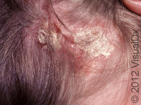 This image displays the thick, white, scaling area typical to psoriasis.