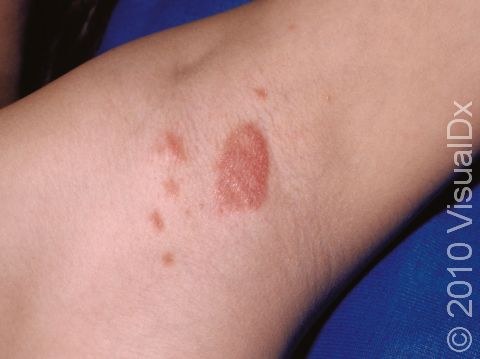 This image displays the fine, scaly, slightly elevated lesions in the armpit (axilla) in psoriasis.