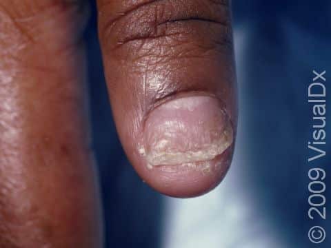 This image displays a nail that is lifting up (onycholysis) due to psoriasis.