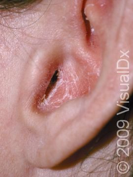 Psoriasis of the ear typically involves the ear canal and appears as redness with white scale.