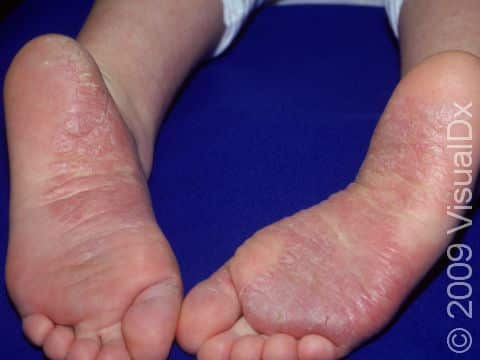 Psoriasis on the bottoms of feet may affect the instep of the sole as well as areas of friction.