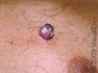 Pyogenic Granuloma – Adult