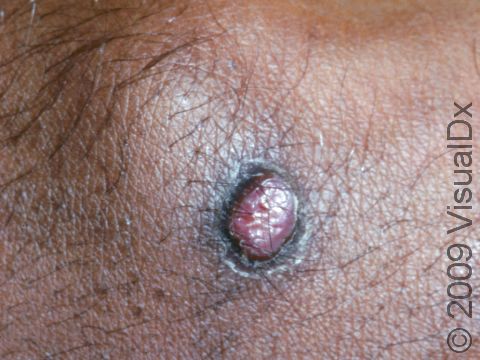 A pyogenic granuloma often has a small 