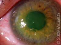 Recurrent Corneal Erosion – Adult