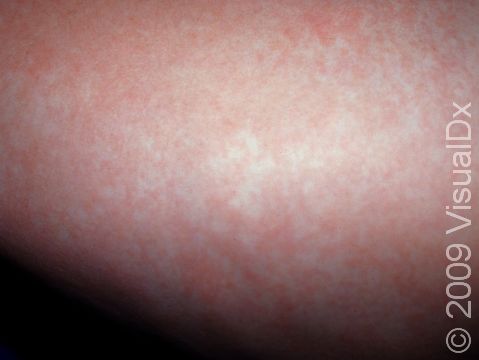 In roseola (sixth disease), the rash is pink to red and is typically widespread.