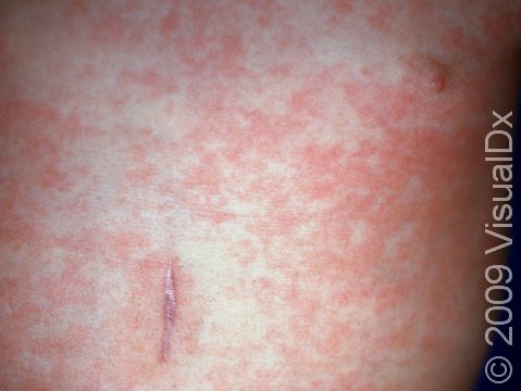 This image displays the rash of roseola (sixth disease) that follows a high fever.