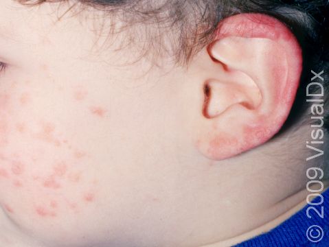 The rash of roseola (sixth disease) affect the face and ears of this infant.