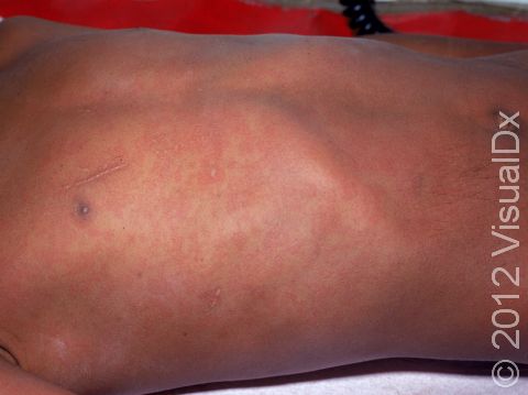 In people with darker sin, the diffuse red to pink rash of measles is harder to see; the few normal areas of skin can be seen near the nipple area in this child.