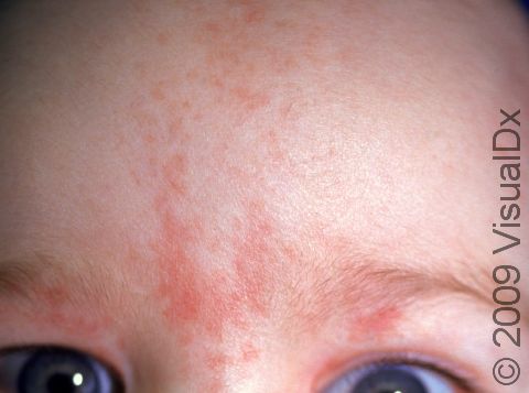 Salmon patches frequently occur at the center of the forehead.