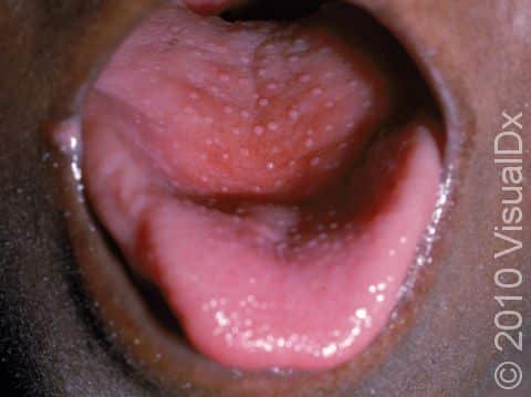 This image displays the sandpaper-like appearance on the chin and a red tongue with red dots (red strawberry tongue) typical of scarlet fever.