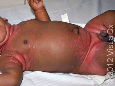 Seborrheic dermatitis frequently involves the diaper area and other body folds, as seen in this infant.