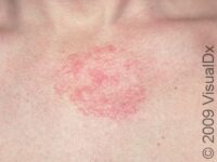 Seborrheic Dermatitis – Adult