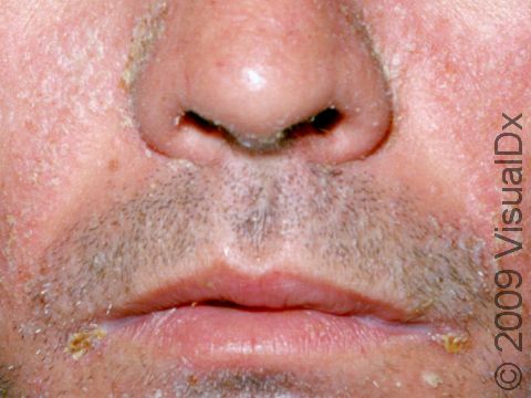 This image displays severe seborrheic dermatitis in the skin creases between the cheeks and the upper lip.