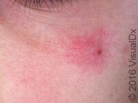 Spider Angioma – Adult