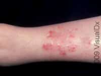 Stasis Dermatitis – Adult