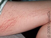 Stretch Marks (Striae) – Adult