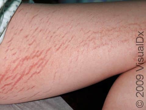 Striae (stretch marks) often follow weight gain or pregnancy.