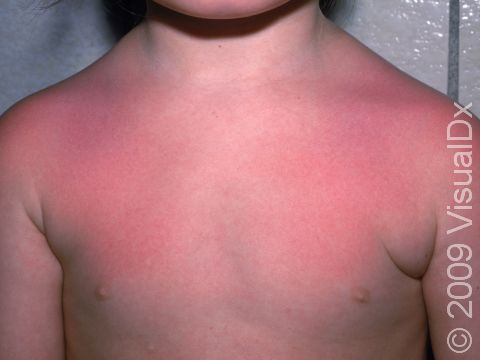 Sunburns on the shoulders and upper chest are very common and range in color from pink to red.