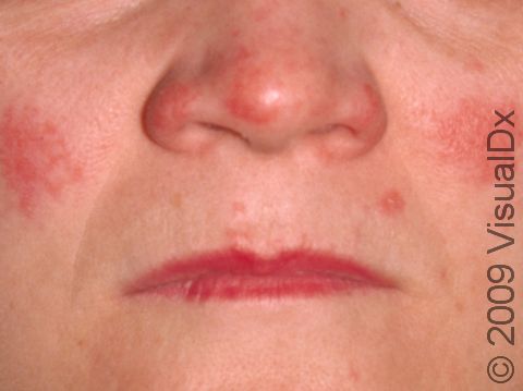 This image displays the red, slightly scaly, and elevated lesions on the cheeks and nose in systemic lupus erythematosus.