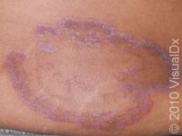 Ringworm (Tinea Corporis) – Adult