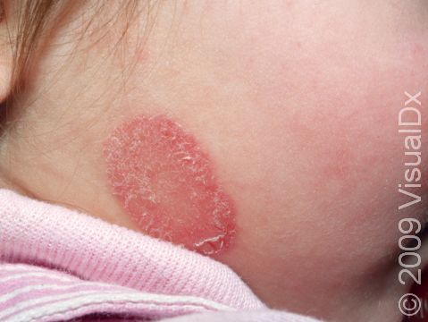 This image displays a classic occurrence of tinea faciale (ringworm) on the neck.