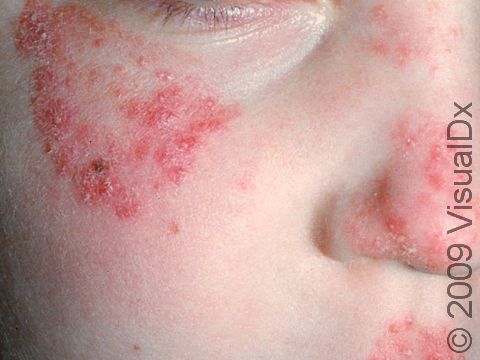 Tinea of the face can cause red, scaly, raised skin lesions.