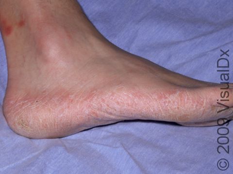 Tinea pedis (athlete's foot) often causes a 