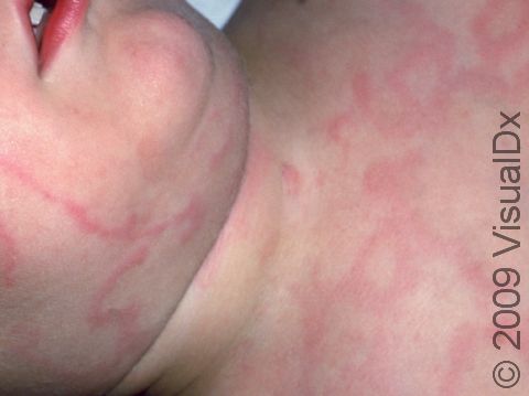 Urticaria (hives) often causes ring-like and curving line-like shapes.