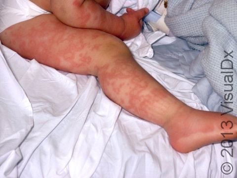 This image displays extensive urticaria (hives).