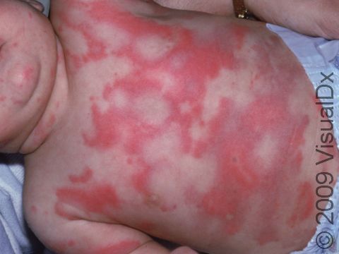 This image displays urticaria (hives), which can produce bizarre shapes.