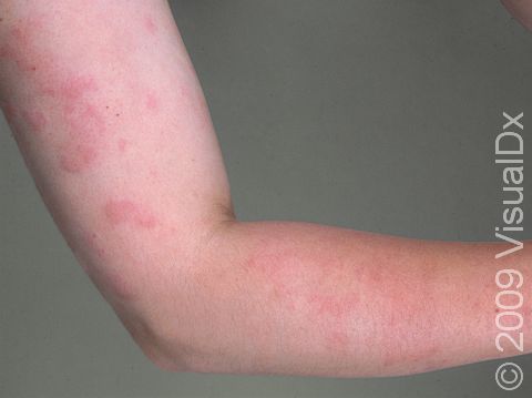 This image displays urticaria (hives).